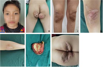 Pediatric patients with familially inherited sitosterolemia: Two case reports